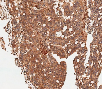 IHC testing of FFPE human colon carcinoma tissue with MCT4 antibody. HIER: steam section in pH6 citrate buffer for 20 min and allow to cool prior to staining.