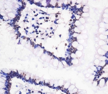 IHC testing of FFPE human small intestine tissue with NGN3 antibody. HIER: steam section in pH6 citrate buffer for 20 min and allow to cool prior to staining.