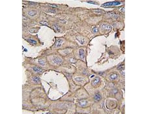 IHC testing of FFPE human lung carcinoma tissue with Annexin A2 antibody. HIER: steam section in pH6 citrate buffer for 20 min and allow to cool prior to staining.