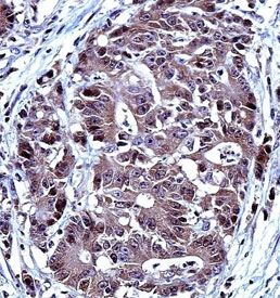 IHC testing of FFPE human colon carcinoma tissue with IRF7 antibody. HIER: steam section in pH6 citrate buffer for 20 min and allow to cool prior to staining.
