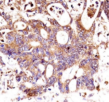 Catenin Beta Antibody Human Colon Carcinoma Immunohistochemistry. IHC testing of FFPE human colon carcinoma tissue with Catenin Beta antibody. HIER: steam section in pH6 citrate buffer for 20 min and allow to cool prior to staining.