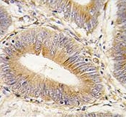 AKR1B1 Antibody Colon Carcinoma IHC. Immunohistochemistry testing of FFPE human colon carcinoma tissue with AKR1B1 antibody. HIER: steam section in pH6 citrate buffer for 20 min and allow to cool prior to staining.
