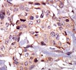 IHC testing of FFPE human breast cancer tissue with Tec antibody. HIER: steam section in pH6 citrate buffer for 20 min and allow to cool prior to staining.