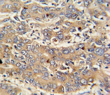 IHC testing of FFPE human hepatocarcinoma tissue with PIGR antibody. HIER: steam section in pH6 citrate buffer for 20 min and allow to cool prior to staining.