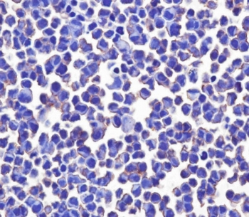 Immunocytochemical testing of PFA-fixed human MCF7 cells with B7-H3 antibody. HIER: pH9 EDTA.