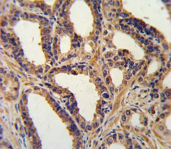 NPPA Antibody Human Prostate Carcinoma IHC. Immunohistochemistry staining of FFPE human prostate carcinoma tissue using NPPA antibody demonstrates predominantly cytoplasmic staining within gland-forming epithelial tumor cells, consistent with expression of Natriuretic Peptide Precursor A (NPPA), the precursor of Atrial Natriuretic Peptide (ANP/ANF). NPPA is a peptide hormone precursor that participates in endocrine signaling pathways regulating cardiovascular homeostasis, fluid balance, and intercellular communication. The observed epithelial staining pattern supports the utility of NPPA antibody for studies of peptide hormone expression, endocrine signaling networks, and natriuretic peptide biology in normal and neoplastic tissues. HIER: steam section in pH6 citrate buffer for 20 min and allow to cool prior to staining.