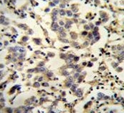 IHC testing of FFPE human testis carcinoma with C6orf58 antibody. HIER: steam section in pH6 citrate buffer for 20 min and allow to cool prior to staining.