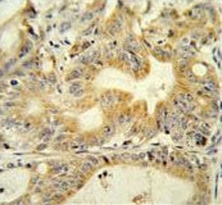 IHC testing of FFPE human colon carcinoma tissue with DcR3 antibody. HIER: steam section in pH6 citrate buffer for 20 min and allow to cool prior to staining.