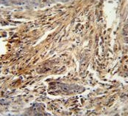 CSF2 Antibody Lung Carcinoma Immunohistochemistry. IHC testing of FFPE human lung carcinoma tissue with CSF2 antibody. HIER: steam section in pH6 citrate buffer for 20 min and allow to cool prior to staining.