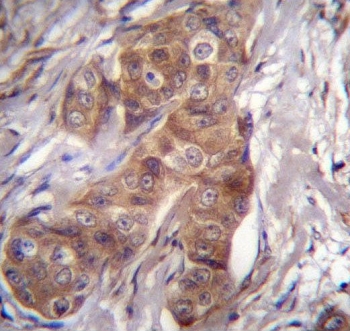 P2RY5 Antibody Human Breast Carcinoma IHC. Immunohistochemical staining of FFPE human breast carcinoma tissue using P2RY5 Antibody. Heat-induced epitope retrieval was performed by steaming tissue sections in pH 6.0 citrate buffer for 20 minutes followed by cooling prior to incubation with the primary antibody. Detection was achieved using an HRP-conjugated secondary antibody with DAB chromogen. Moderate membranous and cytoplasmic staining is observed in the carcinoma cells, consistent with endogenous LPAR6/P2RY5 expression. These results demonstrate that P2RY5 Antibody, a Lysophosphatidic Acid Receptor Antibody, specifically detects receptor expression in FFPE human breast carcinoma tissue.