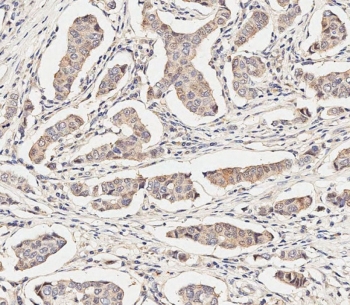 IHC testing of FFPE human breast cancer tissue with MAP2K1 antibody. HIER: steam section in pH9 EDTA for 20 min and allow to cool prior to staining.