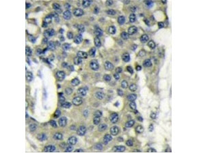 IHC testing of FFPE human breast cancer tissue with EIF4B antibody. HIER: steam section in pH6 citrate buffer for 20 min and allow to cool prior to staining.