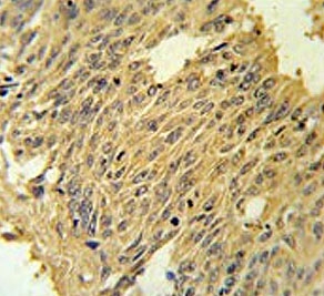 IHC testing of FFPE human lung carcinoma tissue with Mitoferrin-2 antibody. HIER: steam section in pH6 citrate buffer for 20 min and allow to cool prior to staining.