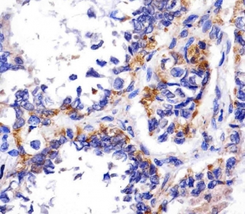 REDD-1 Antibody Human Adenocarcinoma IHC. IHC staining of FFPE human adenocarcinoma tissue with REDD-1 antibody demonstrated cytoplasmic staining in malignant epithelial cells, consistent with the expression pattern of REDD-1 (DDIT4), a stress-responsive regulator of mTOR signaling. REDD-1 is induced by hypoxia, oxidative stress, DNA damage, and metabolic challenges, where it functions to suppress mTOR activity and promote cellular adaptation to adverse conditions. The staining observed within tumor cells is consistent with activation of stress-response pathways commonly associated with the tumor microenvironment. Heat-induced epitope retrieval was performed by steaming tissue sections in pH 6 citrate buffer for 20 minutes and allowing them to cool prior to staining. These results support the utility of REDD-1 Antibody for studies of hypoxia signaling, mTOR pathway regulation, cellular stress responses, and cancer biology.