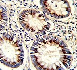 IHC testing of FFPE human colon carcinoma tissue with TYSY antibody. HIER: steam section in pH6 citrate buffer for 20 min and allow to cool prior to staining.