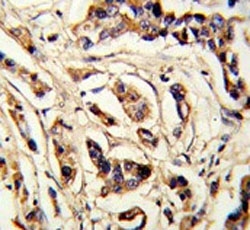 IHC testing of FFPE human breast cancer tissue with TSH beta antibody. HIER: steam section in pH6 citrate buffer for 20 min and allow to cool prior to staining.