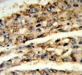 DIO3 Antibody Hepatocellular Carcinoma IHC. Immunohistochemical staining of FFPE human hepatocellular carcinoma tissue using DIO3 Antibody / Thyroid Hormone Metabolism Enzyme Antibody demonstrates cytoplasmic HRP-DAB brown staining within malignant hepatocyte-like tumor cells. The staining pattern is consistent with expression of DIO3 (Iodothyronine Deiodinase 3), the principal thyroid hormone-inactivating enzyme responsible for regulating local concentrations of thyroxine (T4) and triiodothyronine (T3). Positive immunoreactivity within neoplastic hepatic tissue highlights the role of DIO3 in controlling tissue-specific thyroid hormone signaling, metabolic regulation, and cellular growth pathways. These findings support the utility of DIO3 as a marker for studies of endocrine metabolism and thyroid hormone homeostasis in liver malignancies. HIER: steam section in pH6 citrate buffer for 20 min and allow to cool prior to staining.