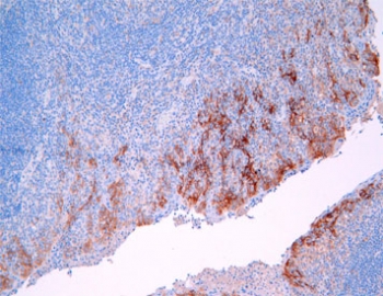 IHC staining of FFPE human tonsil tissue with PD-L1 antibody. HIER: steam section in pH9 EDTA buffer for 20 min and allow to cool prior to staining.