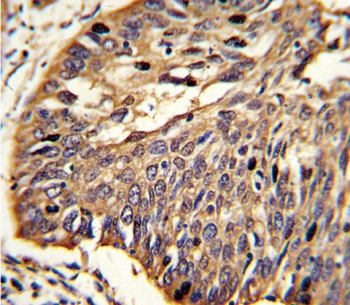 IHC analysis of FFPE human lung carcinoma stained with MyD88 antibody. HIER: steam section in pH6 citrate buffer for 20 min and allow to cool prior to staining.