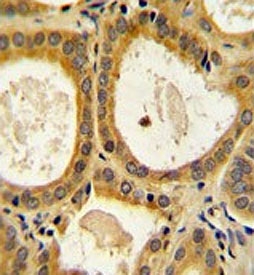 IHC testing of FFPE human prostate carcinoma tissue with CTLA4 antibody. HIER: steam section in pH6 citrate buffer for 20 min and allow to cool prior to staining.