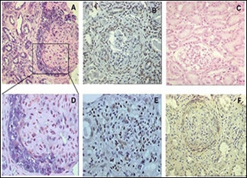 ISH and IMH demonstrating gremlin mRNA and gremlin protein in crescentic PECs and tubular epithelial cells of patients with pauci-immune crescentic GN. In comparison with normal renal tissue in which there is no expression of gremlin mRNA (C), proliferating PECs of glomerular crescents show a strong expression of gremlin mRNA by ISH (A); and gremlin protein expression by IMH (B); immune competent infiltrating interstitial cells are also strongly positive for gremlin staining (E); and CTGF was also expressed in these glomerular crescentic cells (F).