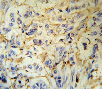 IHC staining of FFPE human breast carcinoma tissue with Fibrinogen alpha antibody. HIER: steam section in pH6 citrate buffer for 20 min and allow to cool prior to staining.