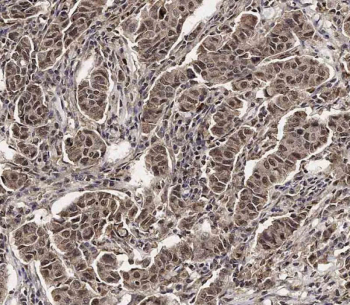 IHC staining of FFPE human breast carcinoma tissue with SCXA antibody. HIER: steam section in pH6 citrate buffer for 20 min and allow to cool prior to staining.