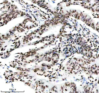 IHC analysis of Histone H3 (acetyl K14) using anti-Histone H3 (acetyl K14) antibody. Histone H3 (acetyl K14) was detected in a paraffin-embedded section of human rectal cancer tissue. Heat mediated antigen retrieval was performed in EDTA buffer (pH 8.0, epitope retrieval solution). The tissue section was blocked with 10% goat serum. The tissue section was then incubated with a dilution of 1:50 rabbit anti-Histone H3 (acetyl K14) antibody overnight at 4oC. Peroxidase Conjugated Goat Anti-rabbit IgG was used as secondary antibody and incubated for 30 minutes at 37oC. The tissue section was developed using an HRP secondary and DAB substrate.
