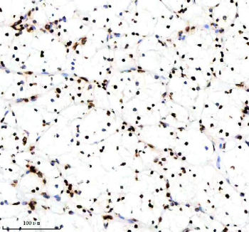 IHC analysis of Histone H3 (acetyl K14) using anti-Histone H3 (acetyl K14) antibody. Histone H3 (acetyl K14) was detected in a paraffin-embedded section of human clear cell renal cell carcinoma tissue. Heat mediated antigen retrieval was performed in EDTA buffer (pH 8.0, epitope retrieval solution). The tissue section was blocked with 10% goat serum. The tissue section was then incubated with a dilution of 1:50 rabbit anti-Histone H3 (acetyl K14) antibody overnight at 4oC. Peroxidase Conjugated Goat Anti-rabbit IgG was used as secondary antibody and incubated for 30 minutes at 37oC. The tissue section was developed using an HRP secondary and DAB substrate.
