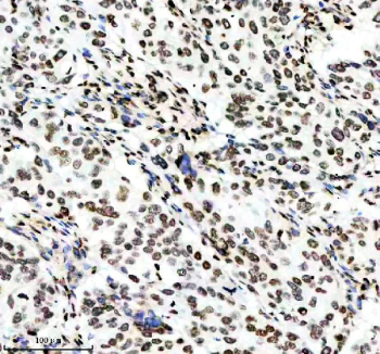 IHC analysis of Histone H3 (acetyl K14) using anti-Histone H3 (acetyl K14) antibody. Histone H3 (acetyl K14) was detected in a paraffin-embedded section of human ovarian cancer tissue. Heat mediated antigen retrieval was performed in EDTA buffer (pH 8.0, epitope retrieval solution). The tissue section was blocked with 10% goat serum. The tissue section was then incubated with a dilution of 1:50 rabbit anti-Histone H3 (acetyl K14) antibody overnight at 4oC. Peroxidase Conjugated Goat Anti-rabbit IgG was used as secondary antibody and incubated for 30 minutes at 37oC. The tissue section was developed using an HRP secondary and DAB substrate.