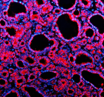IF analysis of TMED10 using anti-TMED10 antibody (red). TMED10 was detected in a paraffin-embedded section of human thyroid cancer tissue. Heat mediated antigen retrieval was performed in EDTA buffer (pH 8.0, epitope retrieval solution). The tissue section was blocked with 10% goat serum. The tissue section was then incubated with 5 ug/ml rabbit anti-TMED10 antibody overnight at 4oC. Cy3 Conjugated Goat Anti-Rabbit IgG was used as secondary antibody at 1:500 dilution and incubated for 30 minutes at 37oC. The section was counterstained with DAPI (blue). Visualize using a fluorescence microscope and filter sets appropriate for the label used.