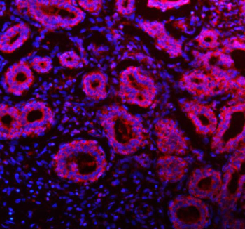 Immunofluorescent staining of FFPE human breast cancer tissue with NDUFA9 antibody (red) and DAPI nuclear stain (blue). HIER: steam section in pH8 EDTA buffer for 20 min.