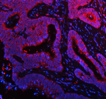 Immunofluorescent staining of FFPE human colon cancer tissue with NDUFA9 antibody (red) and DAPI nuclear stain (blue). HIER: steam section in pH8 EDTA buffer for 20 min.