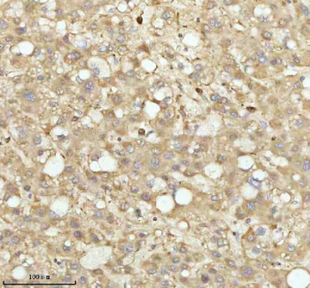 IHC analysis of NDUFA9 using anti-NDUFA9 antibody. NDUFA9 was detected in a paraffin-embedded section of human liver cancer tissue. Heat mediated antigen retrieval was performed in EDTA buffer (pH 8.0, epitope retrieval solution). The tissue section was blocked with 10% goat serum. The tissue section was then incubated with 2 ug/ml rabbit anti-NDUFA9 antibody overnight at 4oC. Peroxidase Conjugated Goat Anti-rabbit IgG was used as secondary antibody and incubated for 30 minutes at 37oC. The tissue section was developed using an HRP secondary and DAB substrate.