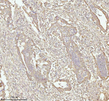 IHC analysis of NDUFA9 using anti-NDUFA9 antibody. NDUFA9 was detected in a paraffin-embedded section of human rectum adenocarcinoma tissue. Heat mediated antigen retrieval was performed in EDTA buffer (pH 8.0, epitope retrieval solution). The tissue section was blocked with 10% goat serum. The tissue section was then incubated with 2 ug/ml rabbit anti-NDUFA9 antibody overnight at 4oC. Peroxidase Conjugated Goat Anti-rabbit IgG was used as secondary antibody and incubated for 30 minutes at 37oC. The tissue section was developed using an HRP secondary and DAB substrate.