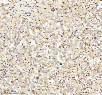 IHC analysis of NDUFA9 using anti-NDUFA9 antibody. NDUFA9 was detected in a paraffin-embedded section of human testicular seminoma tissue. Heat mediated antigen retrieval was performed in EDTA buffer (pH 8.0, epitope retrieval solution). The tissue section was blocked with 10% goat serum. The tissue section was then incubated with 2 ug/ml rabbit anti-NDUFA9 antibody overnight at 4oC. Peroxidase Conjugated Goat Anti-rabbit IgG was used as secondary antibody and incubated for 30 minutes at 37oC. The tissue section was developed using an HRP secondary and DAB substrate.