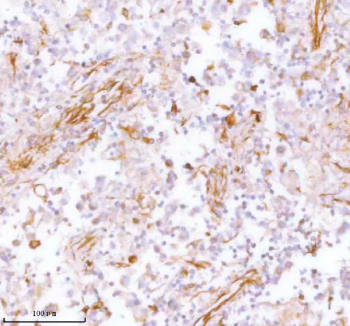 IHC analysis of STC2 using anti-STC2 antibody. STC2 was detected in a paraffin-embedded section of human testicular seminoma tissue. Heat mediated antigen retrieval was performed in EDTA buffer (pH 8.0, epitope retrieval solution). The tissue section was blocked with 10% goat serum. The tissue section was then incubated with 2 ug/ml rabbit anti-STC2 antibody overnight at 4oC. Peroxidase Conjugated Goat Anti-rabbit IgG was used as secondary antibody and incubated for 30 minutes at 37oC. The tissue section was developed using an HRP secondary and DAB substrate.