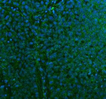 Immunofluorescent staining of FFPE human lung cancer tissue with STC2 antibody (green) and DAPI nuclear stain (blue). HIER: steam section in pH8 EDTA buffer for 20 min.