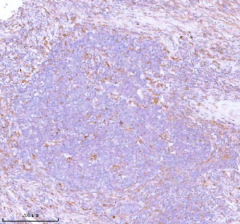 IHC analysis of STC2 using anti-STC2 antibody. STC2 was detected in a paraffin-embedded section of human lung squamous cell carcinoma tissue. Heat mediated antigen retrieval was performed in EDTA buffer (pH 8.0, epitope retrieval solution). The tissue section was blocked with 10% goat serum. The tissue section was then incubated with 2 ug/ml rabbit anti-STC2 antibody overnight at 4oC. Peroxidase Conjugated Goat Anti-rabbit IgG was used as secondary antibody and incubated for 30 minutes at 37oC. The tissue section was developed using an HRP secondary and DAB substrate.