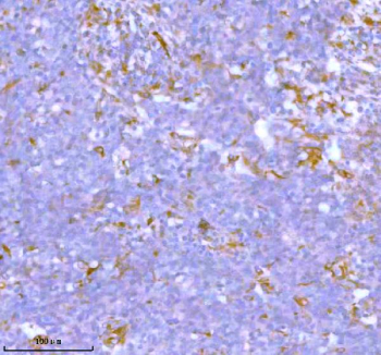 IHC analysis of STC2 using anti-STC2 antibody. STC2 was detected in a paraffin-embedded section of human lung squamous cell carcinoma tissue. Heat mediated antigen retrieval was performed in EDTA buffer (pH 8.0, epitope retrieval solution). The tissue section was blocked with 10% goat serum. The tissue section was then incubated with 2 ug/ml rabbit anti-STC2 antibody overnight at 4oC. Peroxidase Conjugated Goat Anti-rabbit IgG was used as secondary antibody and incubated for 30 minutes at 37oC. The tissue section was developed using an HRP secondary and DAB substrate.