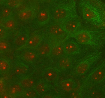 IF analysis of RAD51D using anti-RAD51D antibody (red) and anti-Beta Tubulin antibody (green). RAD51D was detected in immunocytochemical section of cell. Enzyme antigen retrieval was performed using IHC enzyme antigen retrieval reagent for 15 mins. The cells were blocked with 10% goat serum. And then incubated with 5 ug/ml rabbit anti-RAD51D antibody and mouse anti-Beta Tubulin antibody overnight at 4oC. Cy3 Conjugated Goat Anti-Rabbit IgG and DyLight 488 Conjugated Goat Anti-Mouse IgG were used as secondary antibody at 1:500 dilution and incubated for 30 minutes at 37oC. Visualize using a fluorescence microscope and filter sets appropriate for the label used.