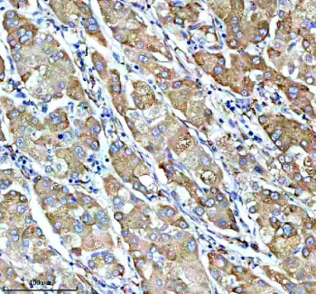 IHC analysis of SUCO using anti-SUCO antibody. SUCO was detected in a paraffin-embedded section of human liver cancer tissue. Heat mediated antigen retrieval was performed in EDTA buffer (pH 8.0, epitope retrieval solution). The tissue section was blocked with 10% goat serum. The tissue section was then incubated with 2 ug/ml rabbit anti-SUCO antibody overnight at 4oC. Peroxidase Conjugated Goat Anti-rabbit IgG was used as secondary antibody and incubated for 30 minutes at 37oC. The tissue section was developed using an HRP secondary and DAB substrate.