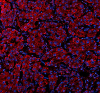 IF analysis of SUCO using anti-SUCO antibody (red). SUCO was detected in a paraffin-embedded section of human liver cancer tissue. Heat mediated antigen retrieval was performed in EDTA buffer (pH 8.0, epitope retrieval solution). The tissue section was blocked with 10% goat serum. The tissue section was then incubated with 5 ug/ml rabbit anti-SUCO antibody overnight at 4oC. Cy3 Conjugated Goat Anti-Rabbit IgG was used as secondary antibody at 1:500 dilution and incubated for 30 minutes at 37oC. The section was counterstained with DAPI (blue). Visualize using a fluorescence microscope and filter sets appropriate for the label used.