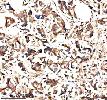 IHC analysis of NEK9 using anti-NEK9 antibody. NEK9 was detected in a paraffin-embedded section of human breast cancer tissue. Heat mediated antigen retrieval was performed in EDTA buffer (pH 8.0, epitope retrieval solution). The tissue section was blocked with 10% goat serum. The tissue section was then incubated with 2 ug/ml rabbit anti-NEK9 antibody overnight at 4oC. Peroxidase Conjugated Goat Anti-rabbit IgG was used as secondary antibody and incubated for 30 minutes at 37oC. The tissue section was developed using an HRP secondary and DAB substrate.