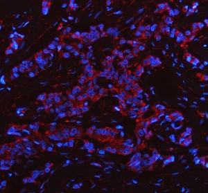 PHGDH Antibody Human Breast Cancer IF. Immunofluorescent staining of FFPE human breast cancer tissue with PHGDH Antibody at 5 ug/ml. HIER was performed using pH 8 EDTA buffer, followed by blocking with 10% goat serum. The tissue section was incubated with rabbit anti-PHGDH antibody overnight at 4Â°C, followed by Cy3 conjugated goat anti-rabbit IgG secondary antibody (red). Nuclei were counterstained with DAPI (blue). PHGDH Antibody demonstrates cytoplasmic staining consistent with Phosphoglycerate Dehydrogenase expression and supports studies of serine biosynthesis, metabolic reprogramming and cancer metabolism pathways.