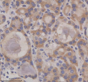 IHC analysis of SIL1 using anti-SIL1 antibody. SIL1 was detected in a paraffin-embedded section of human thyroid cancer tissue. Heat mediated antigen retrieval was performed in EDTA buffer (pH 8.0, epitope retrieval solution). The tissue section was blocked with 10% goat serum. The tissue section was then incubated with 2 ug/ml rabbit anti-SIL1 antibody overnight at 4oC. Peroxidase Conjugated Goat Anti-rabbit IgG was used as secondary antibody and incubated for 30 minutes at 37oC. The tissue section was developed using an HRP secondary and DAB substrate.