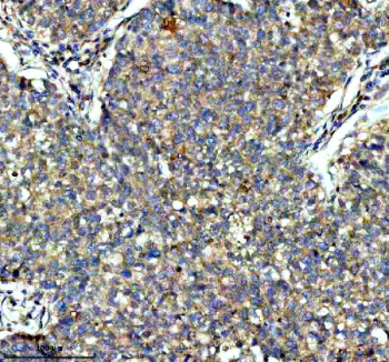 IHC analysis of KCNA6 using anti-KCNA6 antibody. KCNA6 was detected in a paraffin-embedded section of human liver cancer tissue. Heat mediated antigen retrieval was performed in EDTA buffer (pH 8.0, epitope retrieval solution). The tissue section was blocked with 10% goat serum. The tissue section was then incubated with 2 ug/ml rabbit anti-KCNA6 antibody overnight at 4oC. Peroxidase Conjugated Goat Anti-rabbit IgG was used as secondary antibody and incubated for 30 minutes at 37oC. The tissue section was developed using an HRP secondary and DAB substrate.