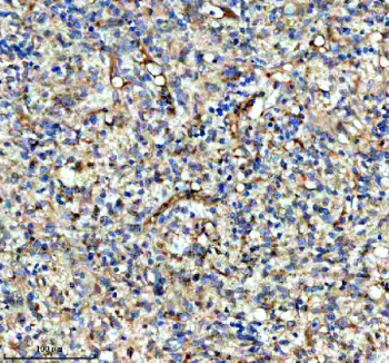IHC analysis of KCNA6 using anti-KCNA6 antibody. KCNA6 was detected in a paraffin-embedded section of human glioma tissue. Heat mediated antigen retrieval was performed in EDTA buffer (pH 8.0, epitope retrieval solution). The tissue section was blocked with 10% goat serum. The tissue section was then incubated with 2 ug/ml rabbit anti-KCNA6 antibody overnight at 4oC. Peroxidase Conjugated Goat Anti-rabbit IgG was used as secondary antibody and incubated for 30 minutes at 37oC. The tissue section was developed using an HRP secondary and DAB substrate.