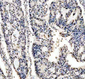IHC analysis of PABPN1 using anti-PABPN1 antibody. PABPN1 was detected in a paraffin-embedded section of human colon cancer tissue. Heat mediated antigen retrieval was performed in EDTA buffer (pH 8.0, epitope retrieval solution). The tissue section was blocked with 10% goat serum. The tissue section was then incubated with 2 ug/ml rabbit anti-PABPN1 antibody overnight at 4oC. Peroxidase Conjugated Goat Anti-rabbit IgG was used as secondary antibody and incubated for 30 minutes at 37oC. The tissue section was developed using an HRP secondary and DAB substrate.