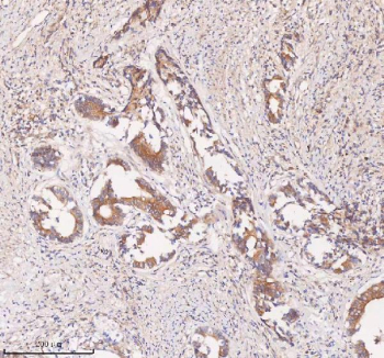 IHC analysis of SAMD9L using anti-SAMD9L antibody. SAMD9L was detected in a paraffin-embedded section of human rectum adenocarcinoma tissue. Heat mediated antigen retrieval was performed in EDTA buffer (pH 8.0, epitope retrieval solution). The tissue section was blocked with 10% goat serum. The tissue section was then incubated with 2 ug/ml rabbit anti-SAMD9L antibody overnight at 4oC. Peroxidase Conjugated Goat Anti-rabbit IgG was used as secondary antibody and incubated for 30 minutes at 37oC. The tissue section was developed using an HRP secondary and DAB substrate.